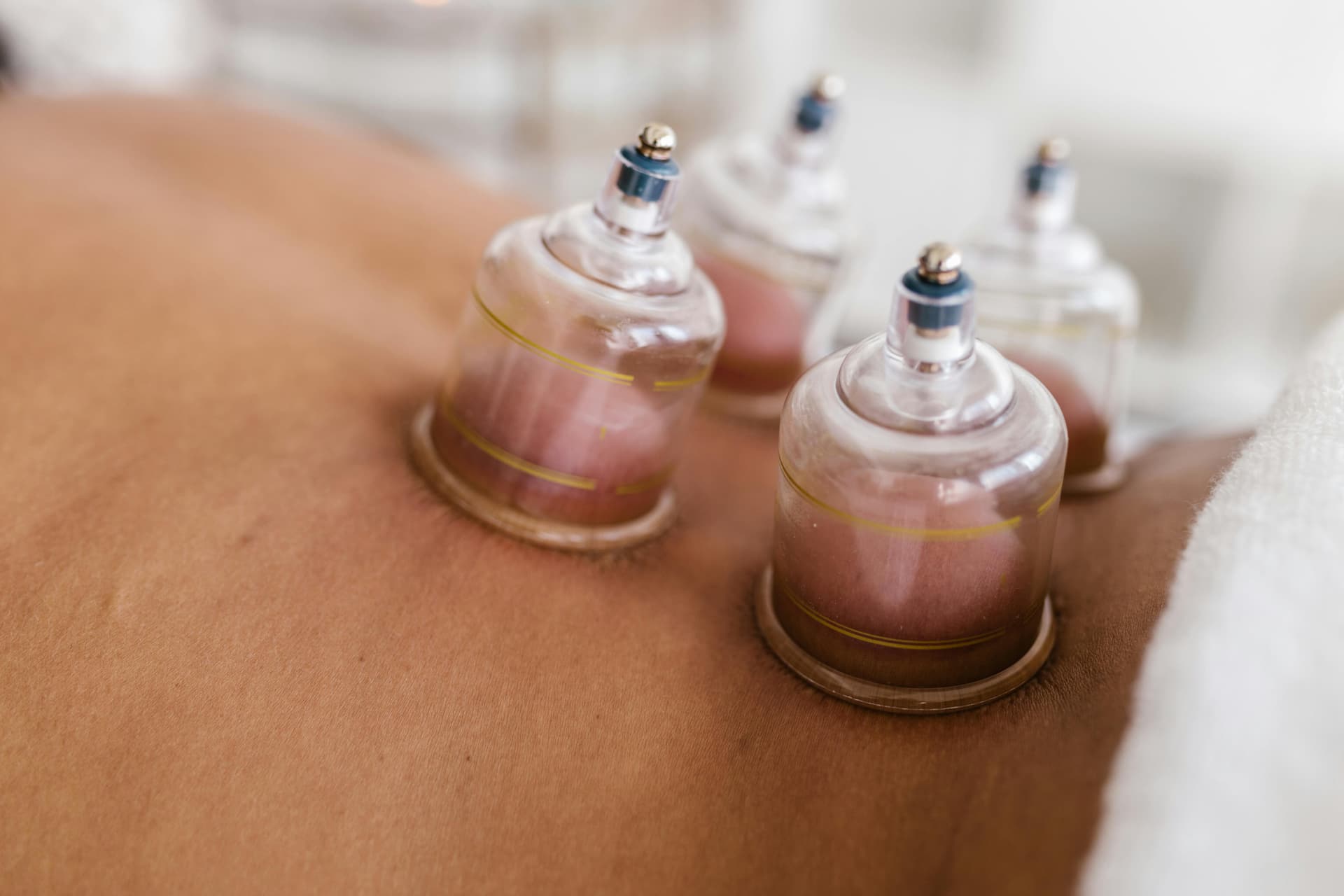Hijama cupping therapy in Sialkot - Traditional treatment
